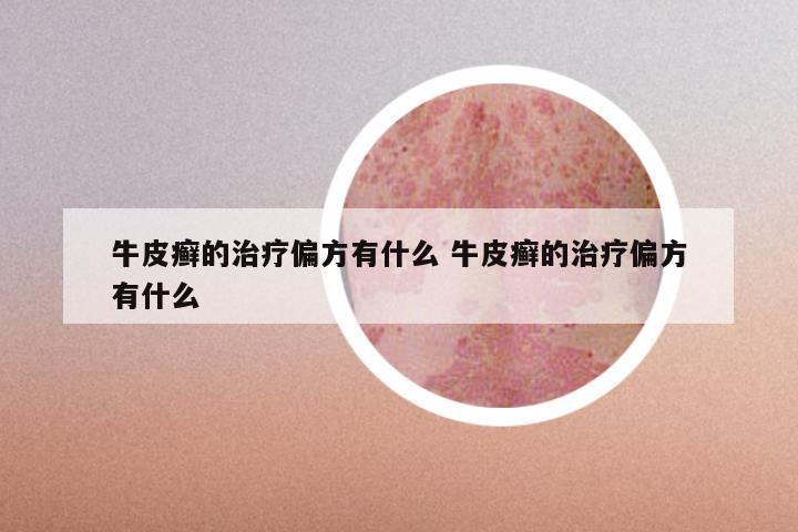牛皮癣的治疗偏方有什么 牛皮癣的治疗偏方有什么