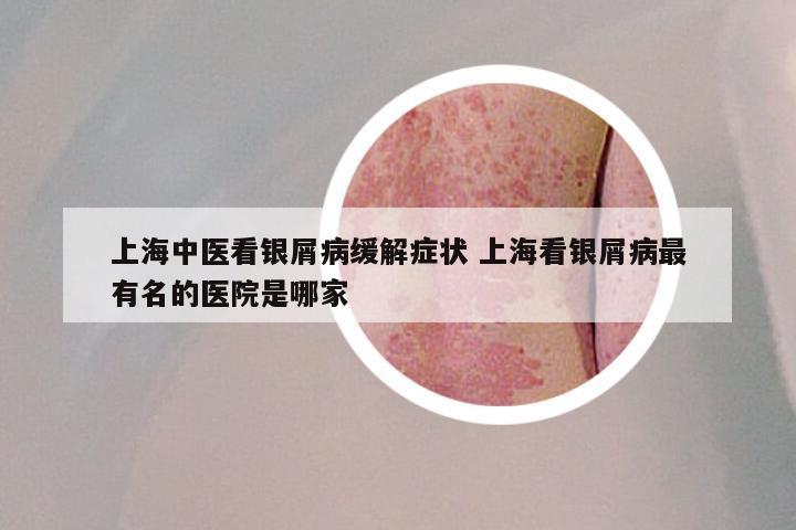 上海中医看银屑病缓解症状 上海看银屑病最有名的医院是哪家