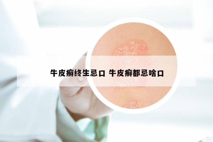 牛皮癣终生忌口 牛皮癣都忌啥口