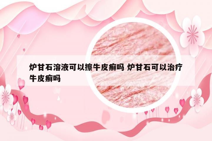 炉甘石溶液可以擦牛皮癣吗 炉甘石可以治疗牛皮癣吗