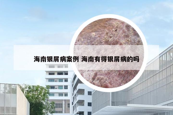 海南银屑病案例 海南有得银屑病的吗