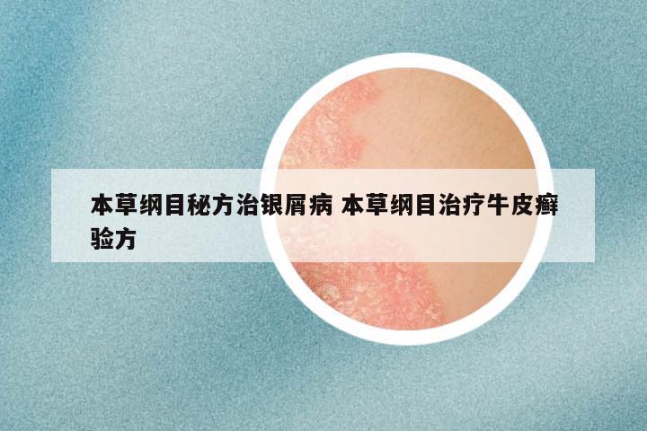 本草纲目秘方治银屑病 本草纲目治疗牛皮癣验方