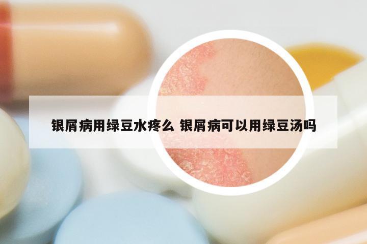 银屑病用绿豆水疼么 银屑病可以用绿豆汤吗