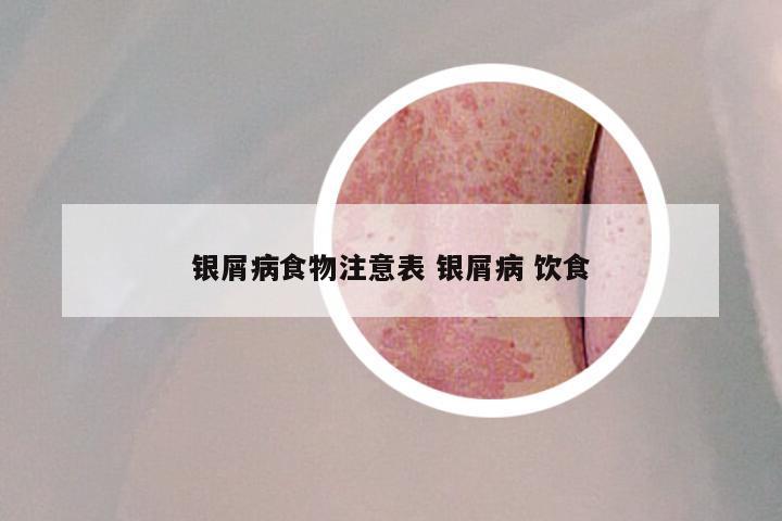 银屑病食物注意表 银屑病 饮食