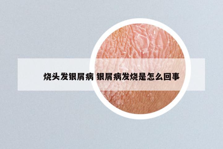 烧头发银屑病 银屑病发烧是怎么回事
