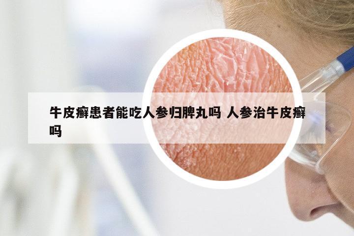 牛皮癣患者能吃人参归脾丸吗 人参治牛皮癣吗