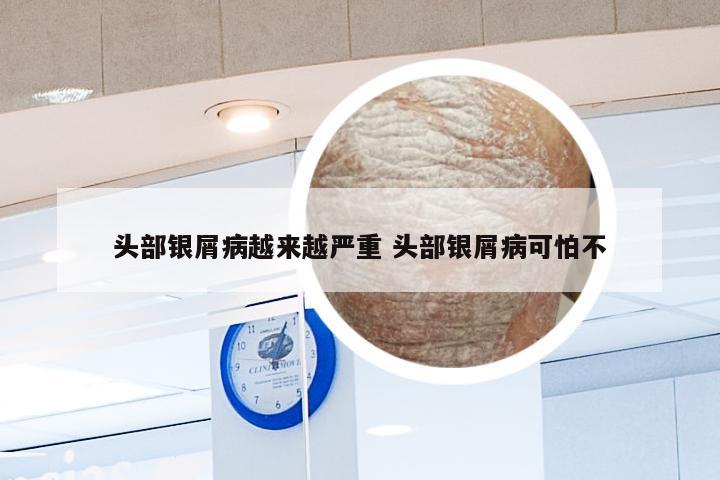 头部银屑病越来越严重 头部银屑病可怕不