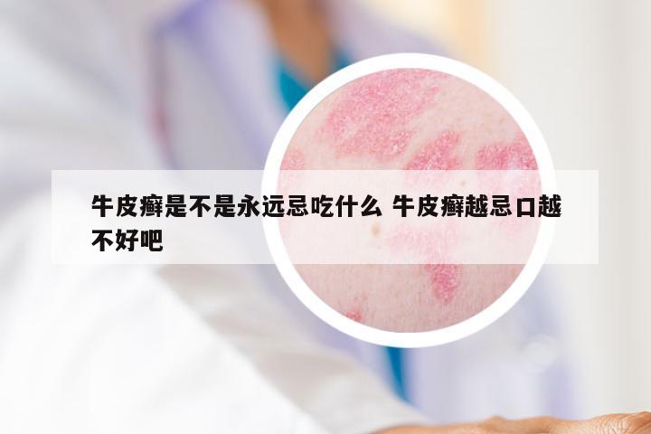 牛皮癣是不是永远忌吃什么 牛皮癣越忌口越不好吧