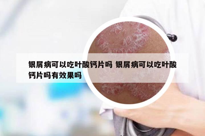 银屑病可以吃叶酸钙片吗 银屑病可以吃叶酸钙片吗有效果吗