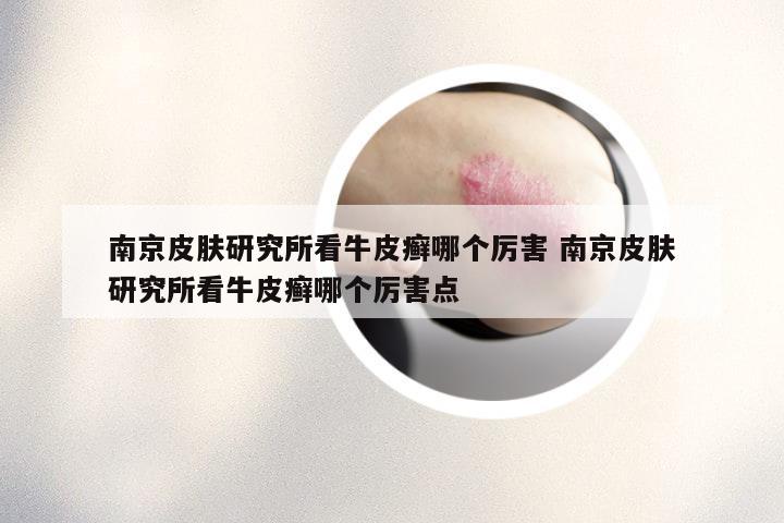 南京皮肤研究所看牛皮癣哪个厉害 南京皮肤研究所看牛皮癣哪个厉害点