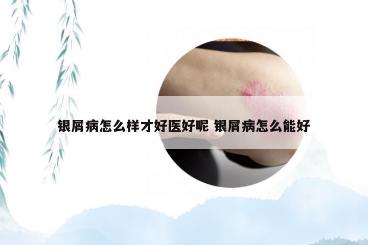 银屑病怎么样才好医好呢 银屑病怎么能好