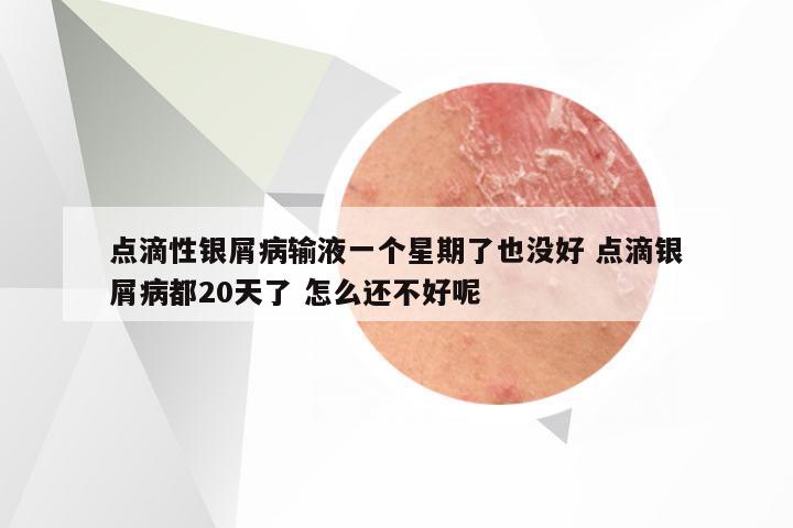点滴性银屑病输液一个星期了也没好 点滴银屑病都20天了 怎么还不好呢
