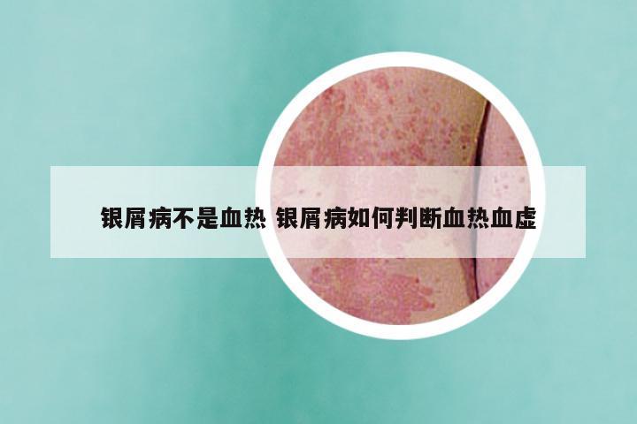 银屑病不是血热 银屑病如何判断血热血虚