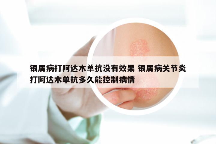 银屑病打阿达木单抗没有效果 银屑病关节炎打阿达木单抗多久能控制病情