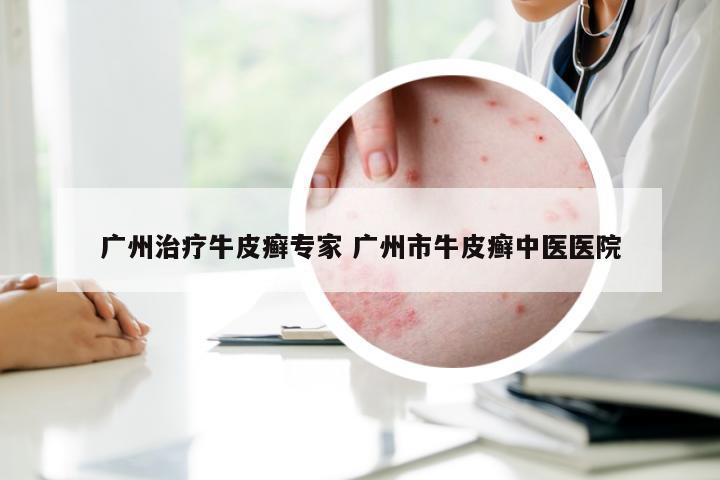 广州治疗牛皮癣专家 广州市牛皮癣中医医院