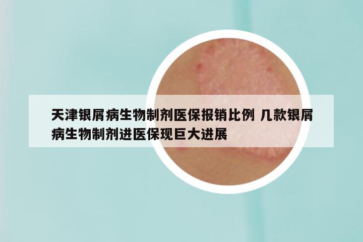 天津银屑病生物制剂医保报销比例 几款银屑病生物制剂进医保现巨大进展