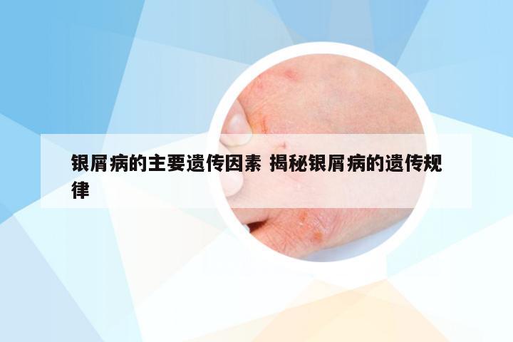 银屑病的主要遗传因素 揭秘银屑病的遗传规律