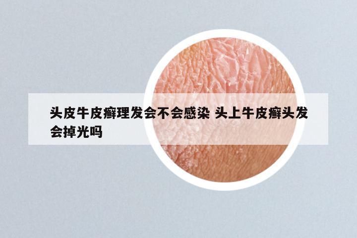 头皮牛皮癣理发会不会感染 头上牛皮癣头发会掉光吗