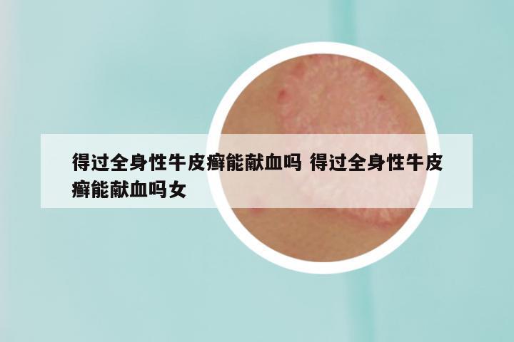 得过全身性牛皮癣能献血吗 得过全身性牛皮癣能献血吗女
