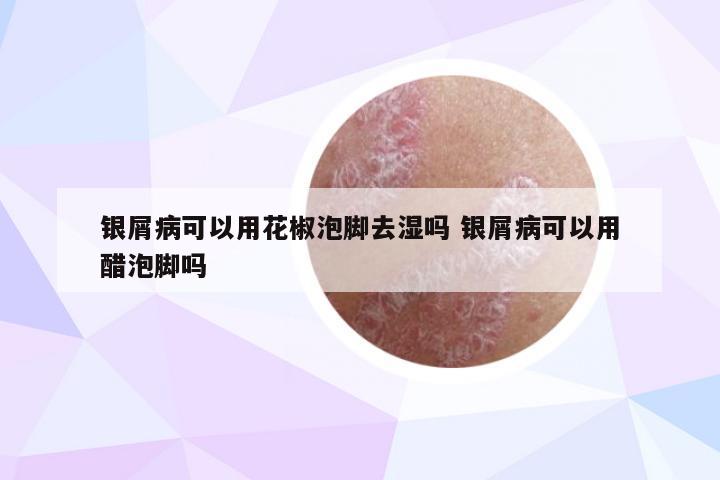 银屑病可以用花椒泡脚去湿吗 银屑病可以用醋泡脚吗