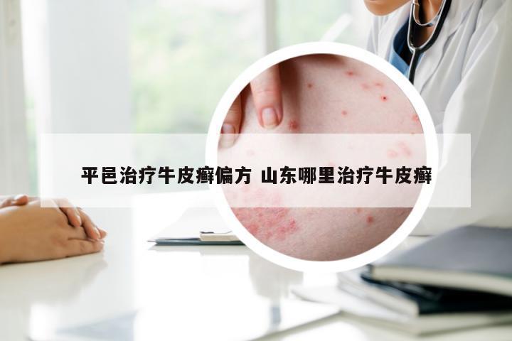 平邑治疗牛皮癣偏方 山东哪里治疗牛皮癣