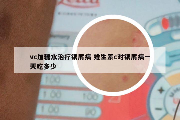 vc加糖水治疗银屑病 维生素c对银屑病一天吃多少