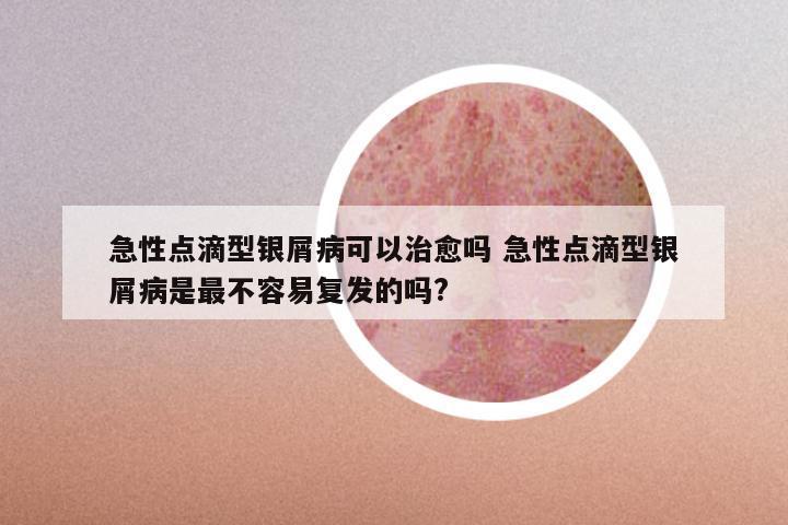 急性点滴型银屑病可以治愈吗 急性点滴型银屑病是最不容易复发的吗?