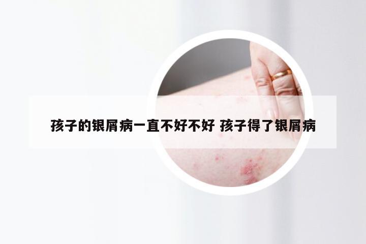 孩子的银屑病一直不好不好 孩子得了银屑病