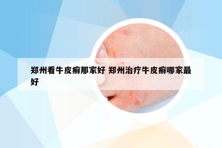 郑州看牛皮癣那家好 郑州治疗牛皮癣哪家最好