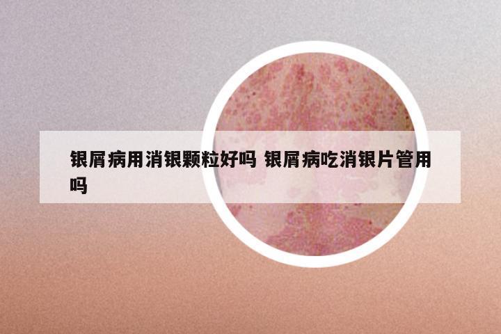 银屑病用消银颗粒好吗 银屑病吃消银片管用吗