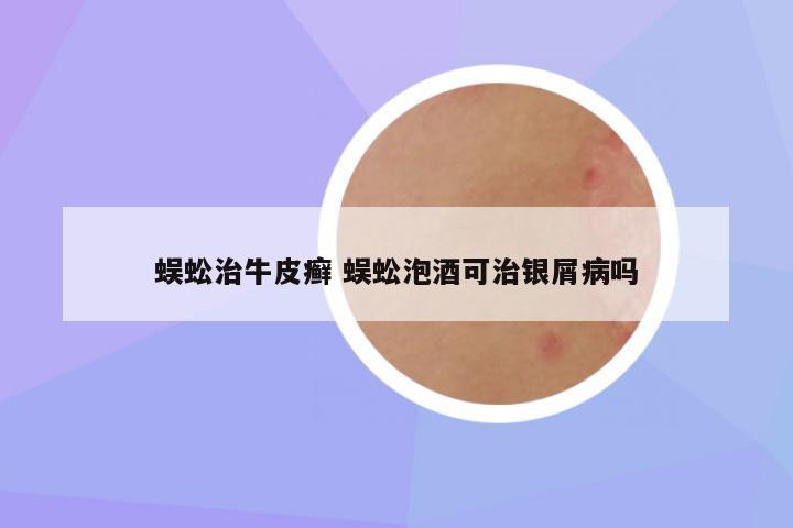 蜈蚣治牛皮癣 蜈蚣泡酒可治银屑病吗
