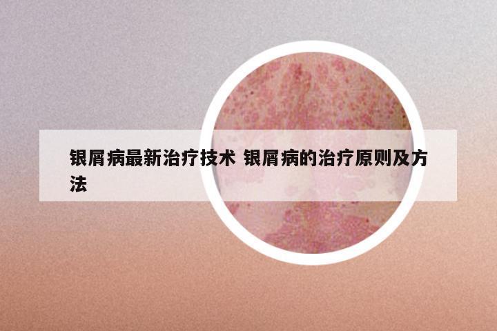 银屑病最新治疗技术 银屑病的治疗原则及方法