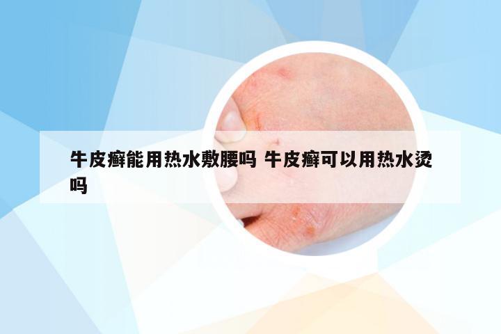 牛皮癣能用热水敷腰吗 牛皮癣可以用热水烫吗