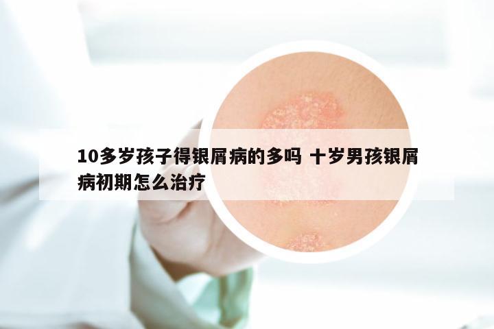 10多岁孩子得银屑病的多吗 十岁男孩银屑病初期怎么治疗