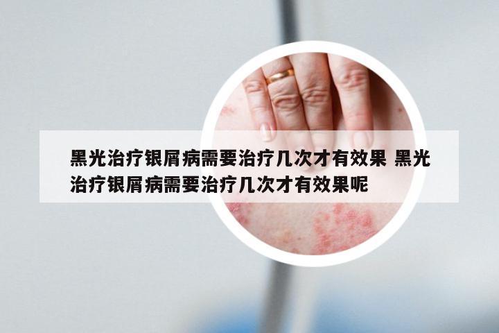 黑光治疗银屑病需要治疗几次才有效果 黑光治疗银屑病需要治疗几次才有效果呢