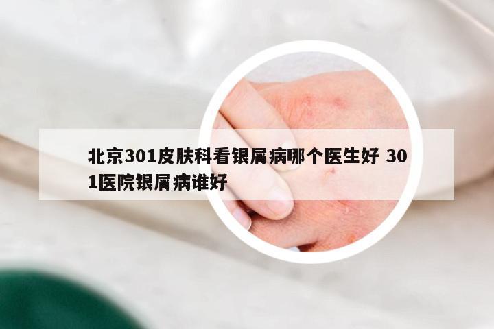 北京301皮肤科看银屑病哪个医生好 301医院银屑病谁好