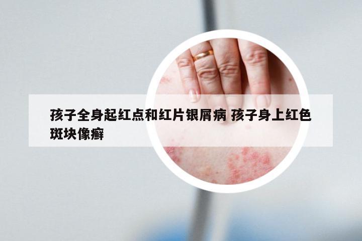 孩子全身起红点和红片银屑病 孩子身上红色斑块像癣