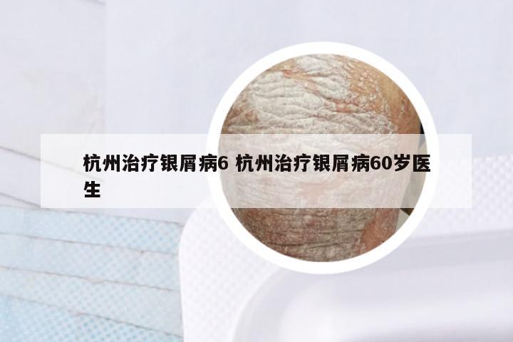 杭州治疗银屑病6 杭州治疗银屑病60岁医生