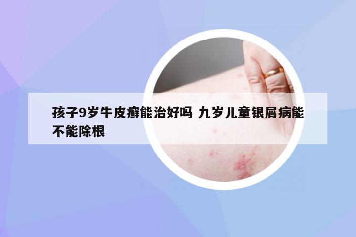 孩子9岁牛皮癣能治好吗 九岁儿童银屑病能不能除根