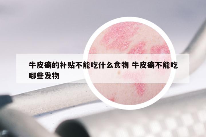 牛皮癣的补贴不能吃什么食物 牛皮癣不能吃哪些发物
