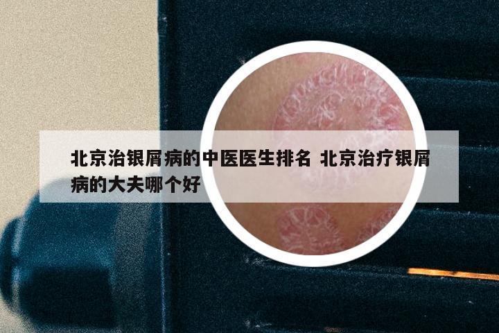 北京治银屑病的中医医生排名 北京治疗银屑病的大夫哪个好