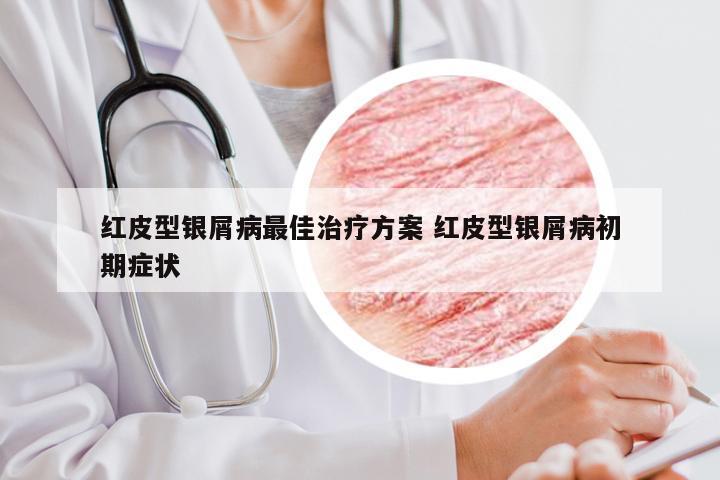 红皮型银屑病最佳治疗方案 红皮型银屑病初期症状