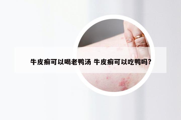 牛皮癣可以喝老鸭汤 牛皮癣可以吃鸭吗?