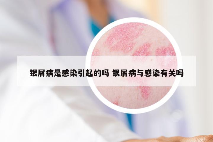 银屑病是感染引起的吗 银屑病与感染有关吗