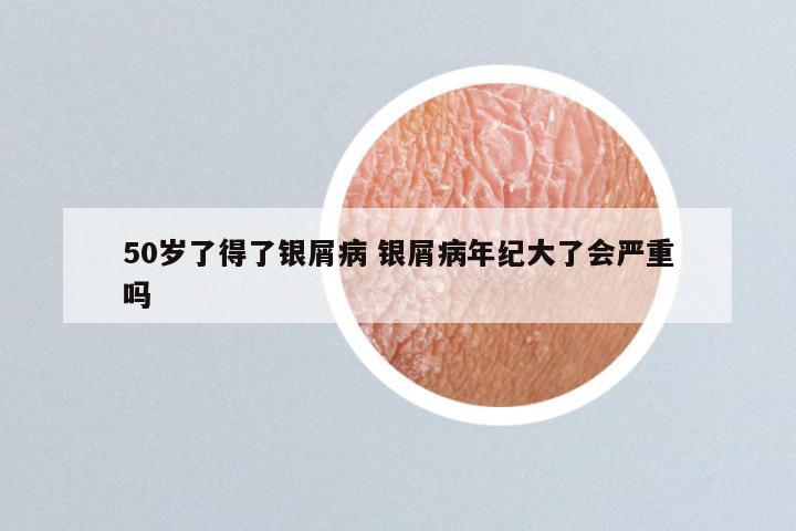 50岁了得了银屑病 银屑病年纪大了会严重吗