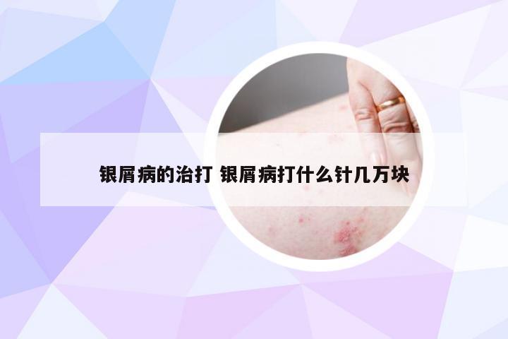 银屑病的治打 银屑病打什么针几万块