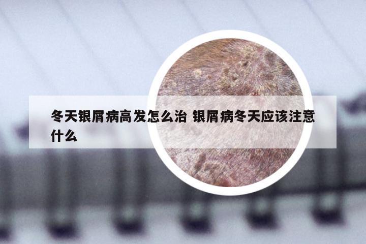 冬天银屑病高发怎么治 银屑病冬天应该注意什么