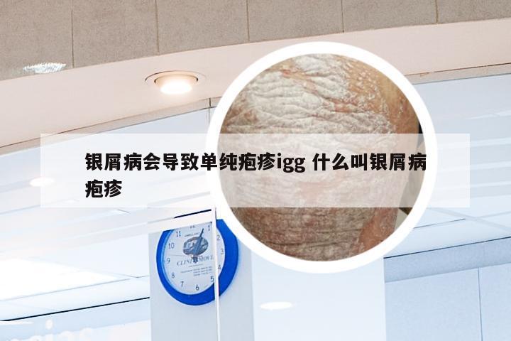 银屑病会导致单纯疱疹igg 什么叫银屑病疱疹