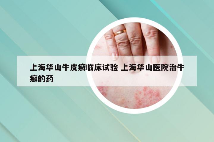 上海华山牛皮癣临床试验 上海华山医院治牛癣的药