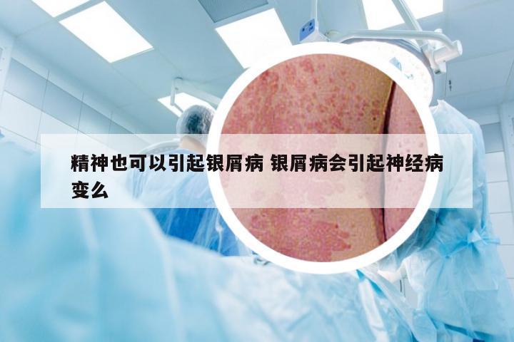 精神也可以引起银屑病 银屑病会引起神经病变么